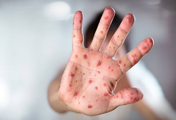 More measles disease cases surfaces in Limpopo